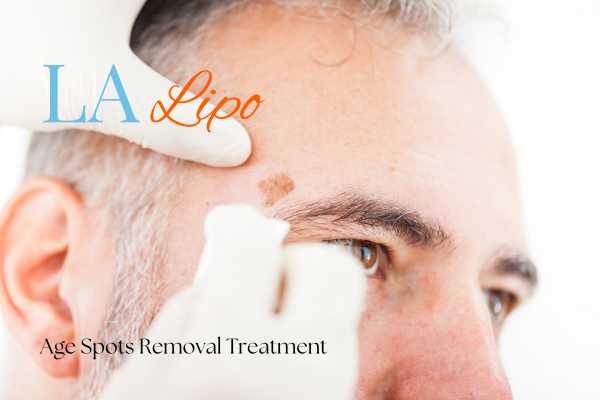What Are the Most Effective Treatments for Age Spots Westbourne Green?