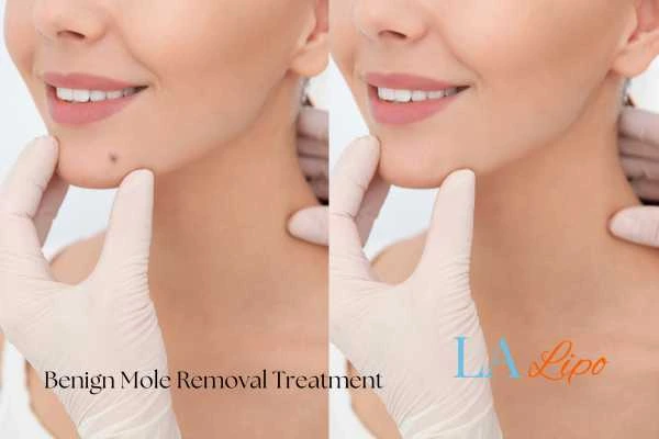 woman's before and after mole removal Westbourne Green results