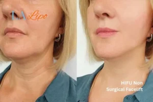 hi-fu for wrinkles Westbourne Green before and after results