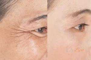 Before and after results of woman - HI-fu wrinkles reduction treatment Westbourne Green