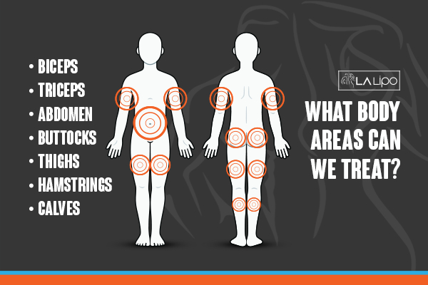 Graphic to show areas you can have LA-EMS Body Sculpting Westbourne Green treatment.