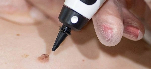 skin tag removal using cryopen Westbourne Green