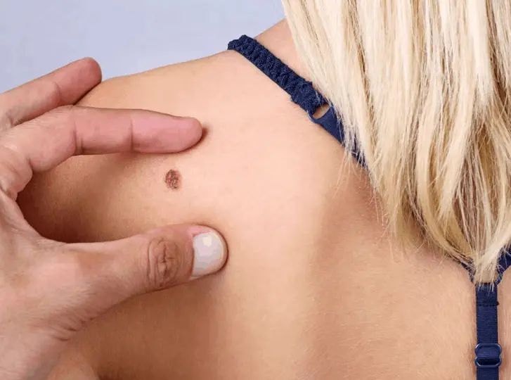 woman having mole removal Westbourne Green consultation before treatment.