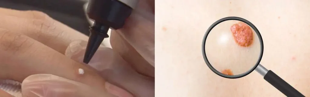 Cryopen for mole removal Westbourne Green - speak to our team today!