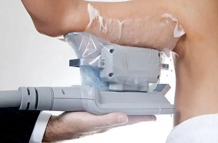 Picture of fat freezing Westbourne Green on the upper arms.