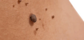image of a skin tag Westbourne Green