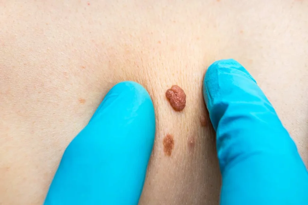 Consultant examining a skin tag Westbourne Green