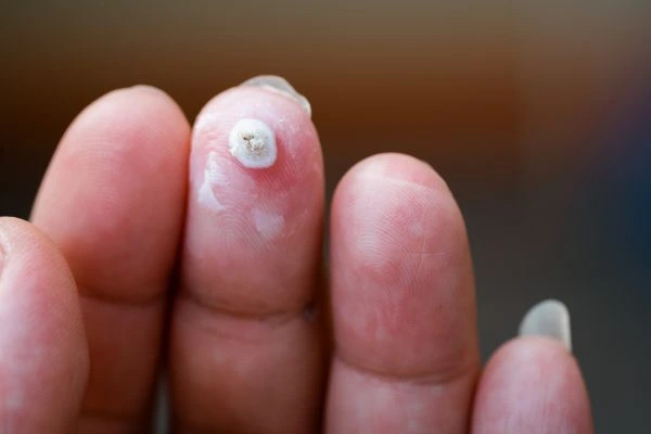 wart on person finger - cryotherapy to treat from LA LIPO Westbourne Green