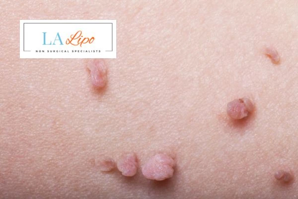 Does cryopen skin tag removal Westbourne Green hurt? Find out now call our team today!