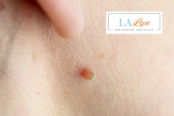 Book skin tag removal Westbourne Green today speak to our team now!