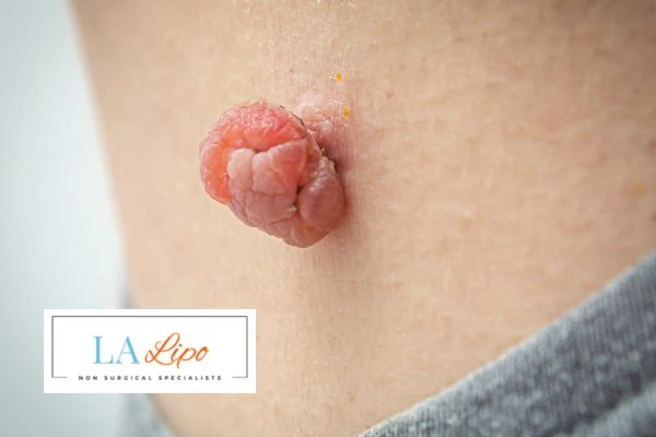 Interested in skin tag removal Westbourne Green? Concerned about the pain? Find out more today!