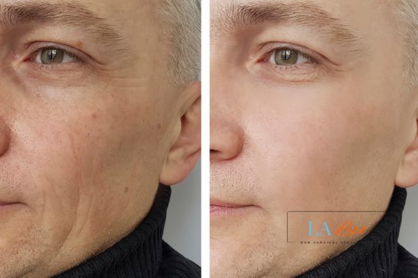 See the amazing results of Morpheus8 Treatment Westbourne Green!
