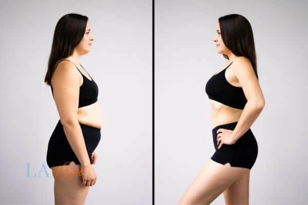 Picture of womans before and after using LA-EMS body sculpting to improve her core strength Westbourne Green