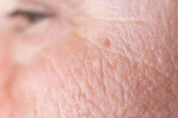 close up picture of a woman's face showing an age spot Westbourne Green
