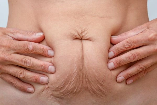 Should I Combine Diastasis Recti Treatment with Body Contouring for Better Results Westbourne Green?
