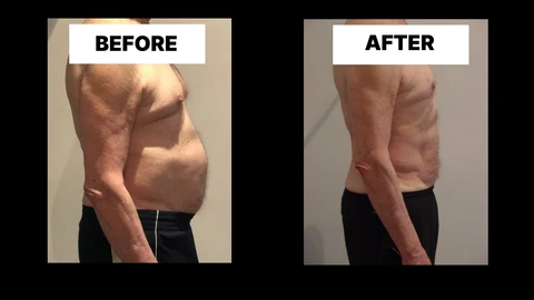 What Symptoms Can Diastasis Recti Cause in Men? Weak Core, Back Pain and Poor Posture Westbourne Green